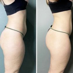 Anesi Lipoaminocel Cream 17.6oz 3