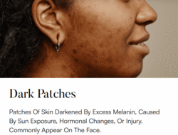 Superfrecator 6800M 3rd Generation - Removes Skin Imperfections + Plasma Fibroblast Skin Tightening 12 dark patches